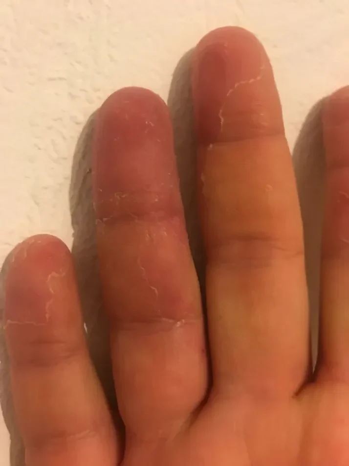 brulure main mme schmitt apres15jours 02