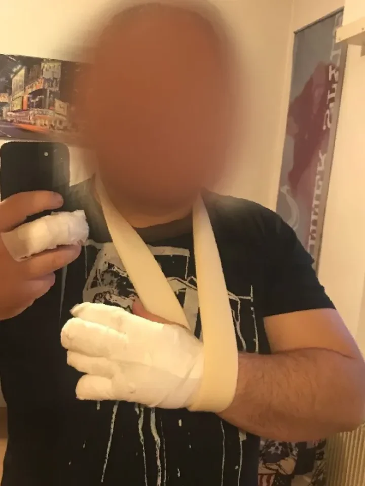 brulure mains mme schmitt 02