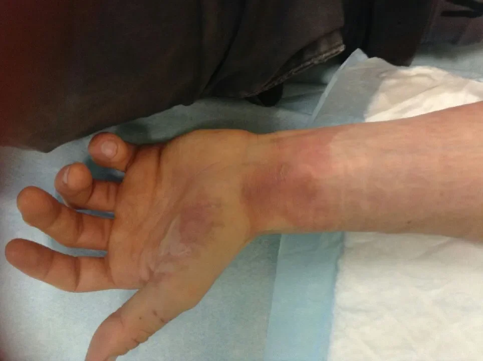 romain brulure main 01