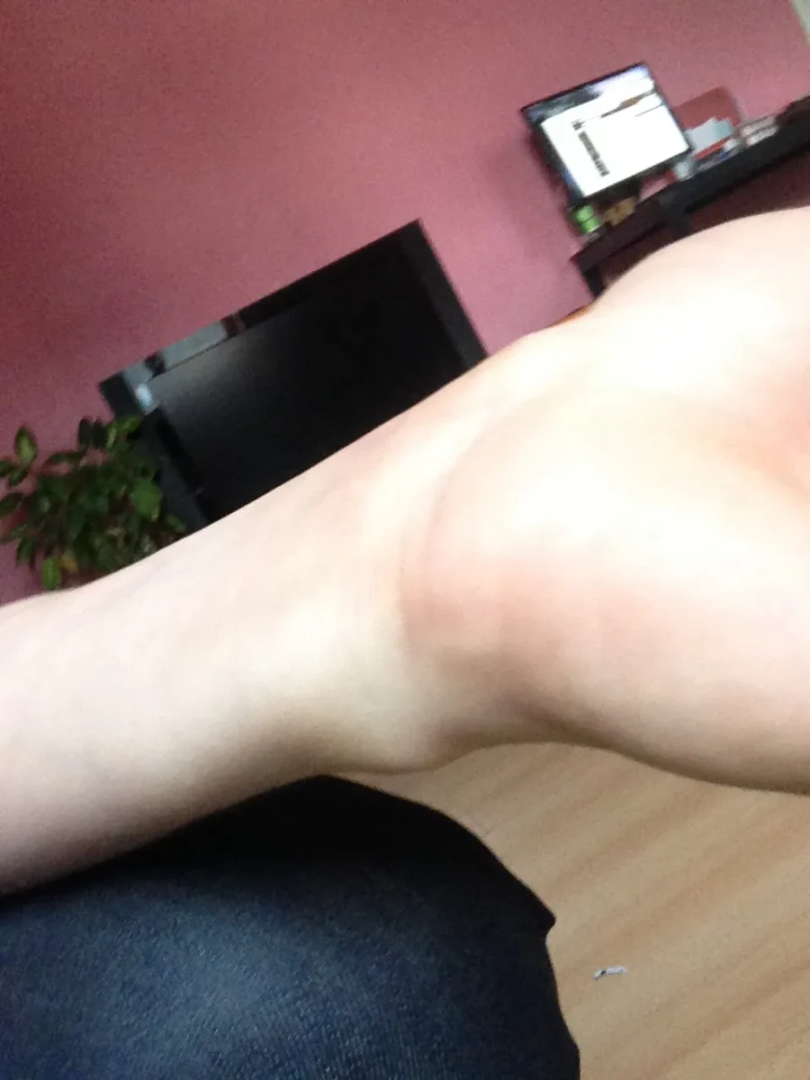 romain brulure main 1mois après 01