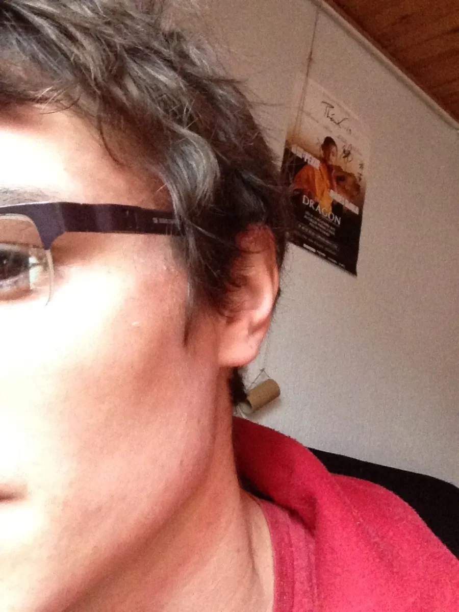 romain brulure visage 1mois après 01