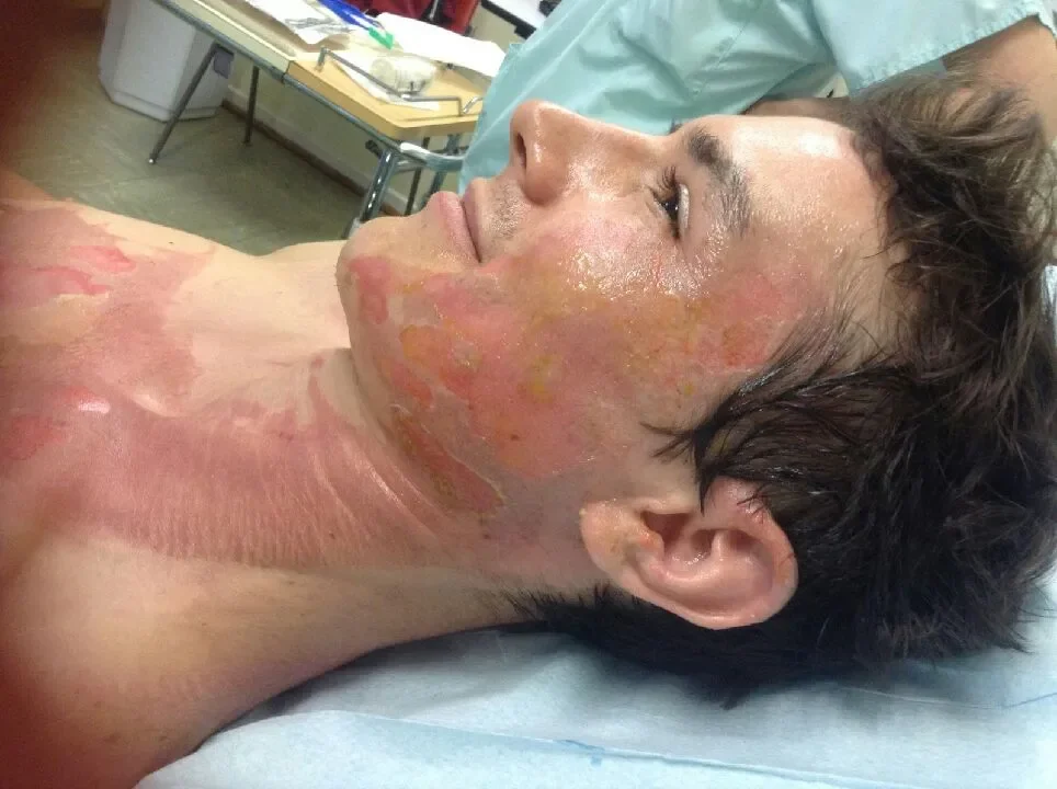 romain brulure visage thorax 01