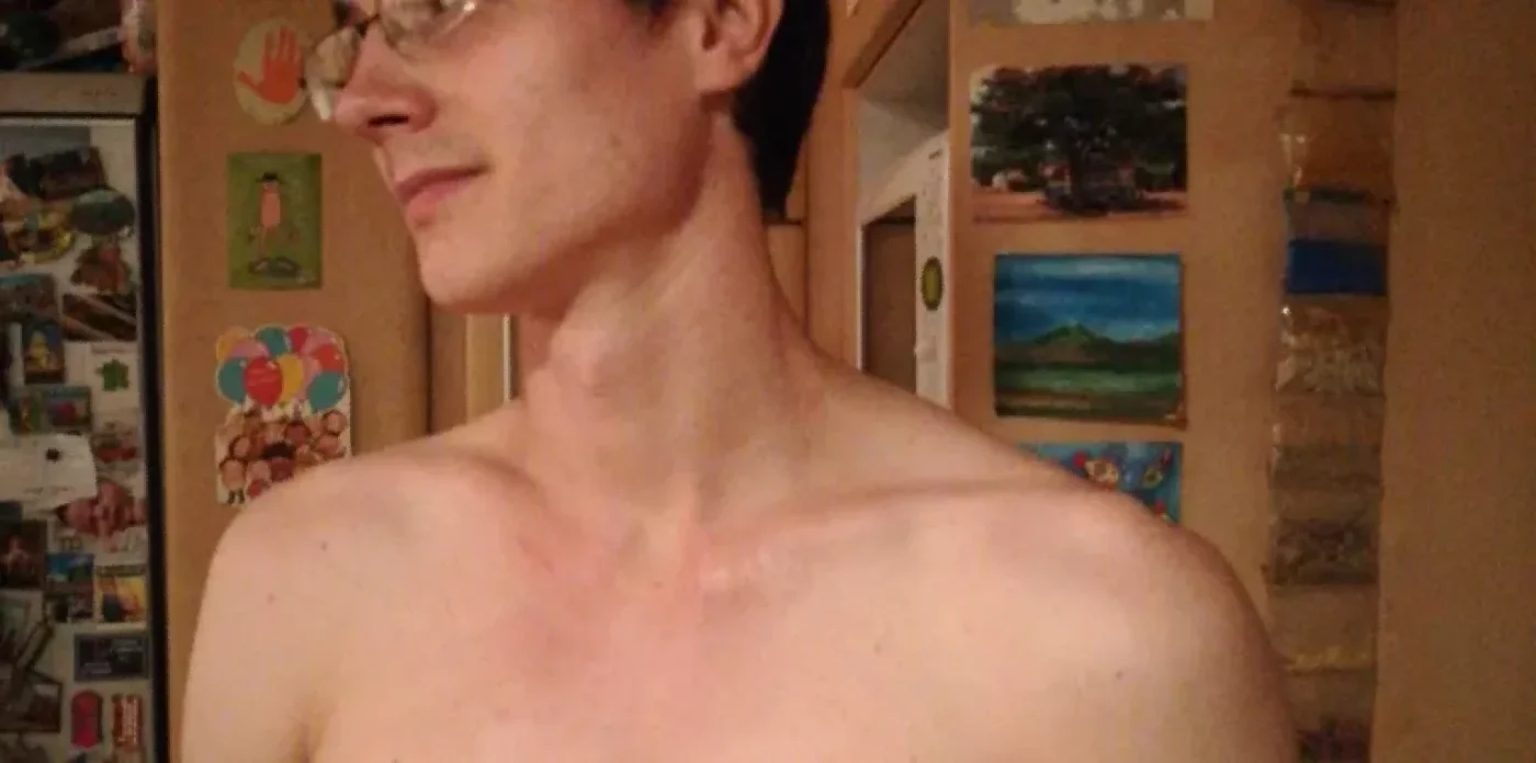 romain brulure visage thorax 10mois après 01