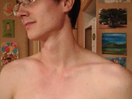 romain brulure visage thorax 10mois après 02