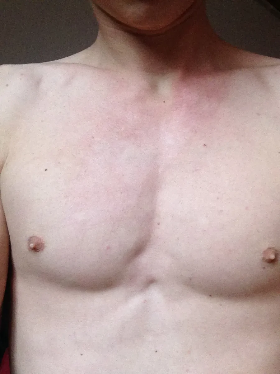 romain brulure visage thorax 1mois après 01